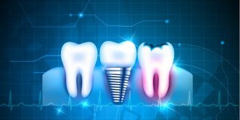 Dijital Diş Hekimliği ve CAD/CAM Destekli Dijital Dolgu Dönemi