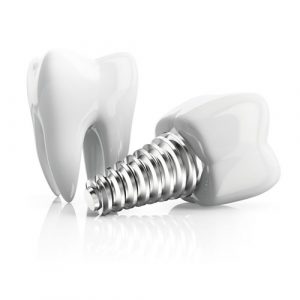 İmplant Markaları 15 dental implant