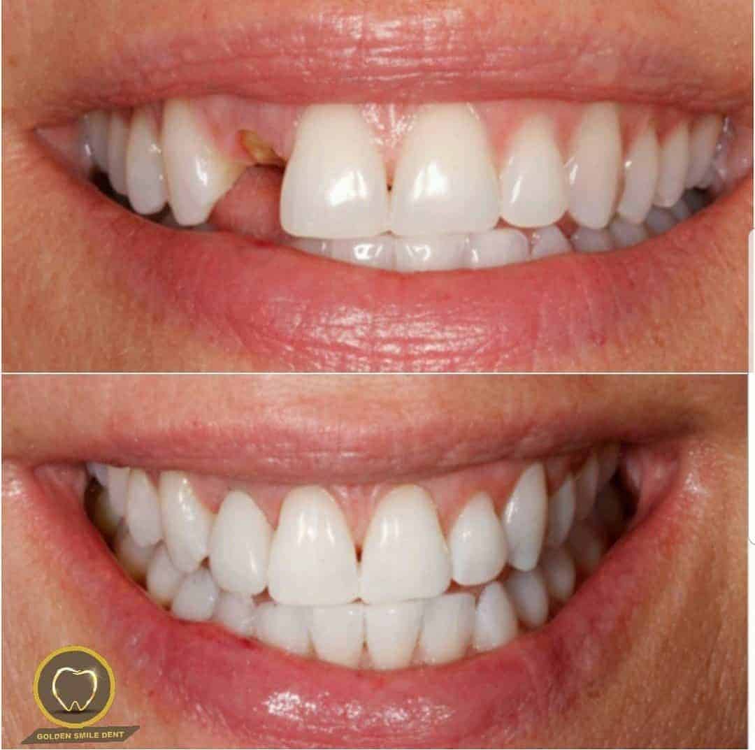 İmplant | İmplant Markaları | Implant Fiyatları 2020