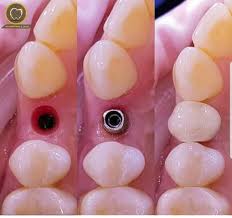 Tek Diş İmplant 16 tek diş implant
