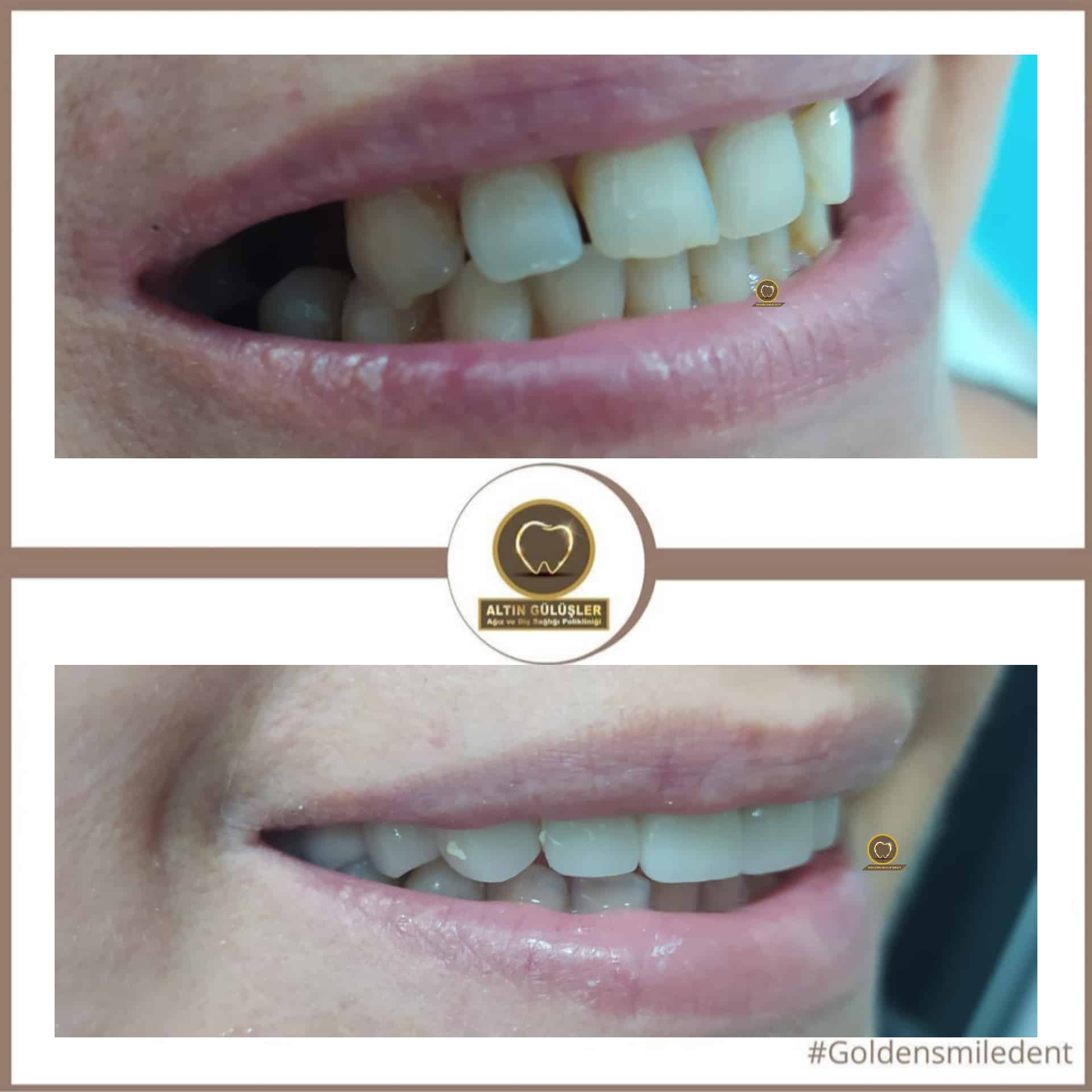 Tek Diş İmplant 15 implant uygulaması