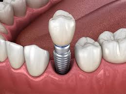 Dental implants 14 dental implants